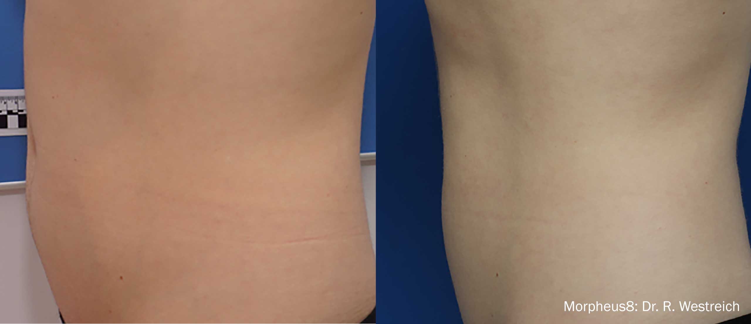 RW-Morpheus8_1b_Abdomen