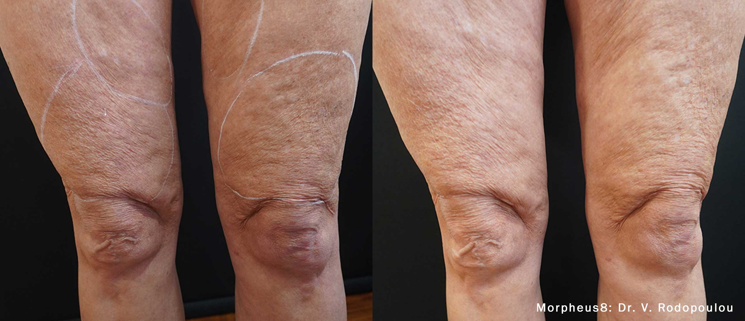 VR_Morpheus8_1_1txThighs63yrs